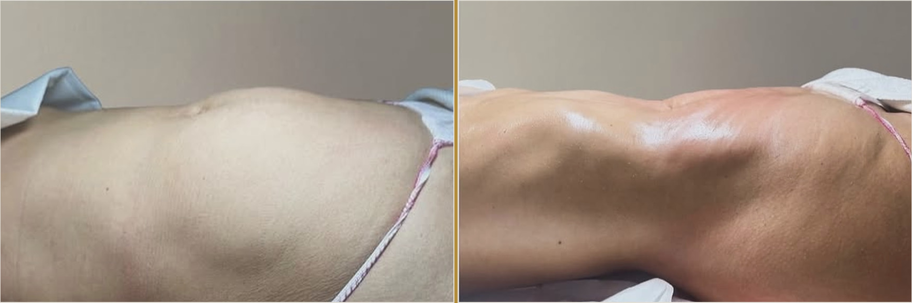 NOMI SCULPT Abdomen & Hips — real client before and after one session