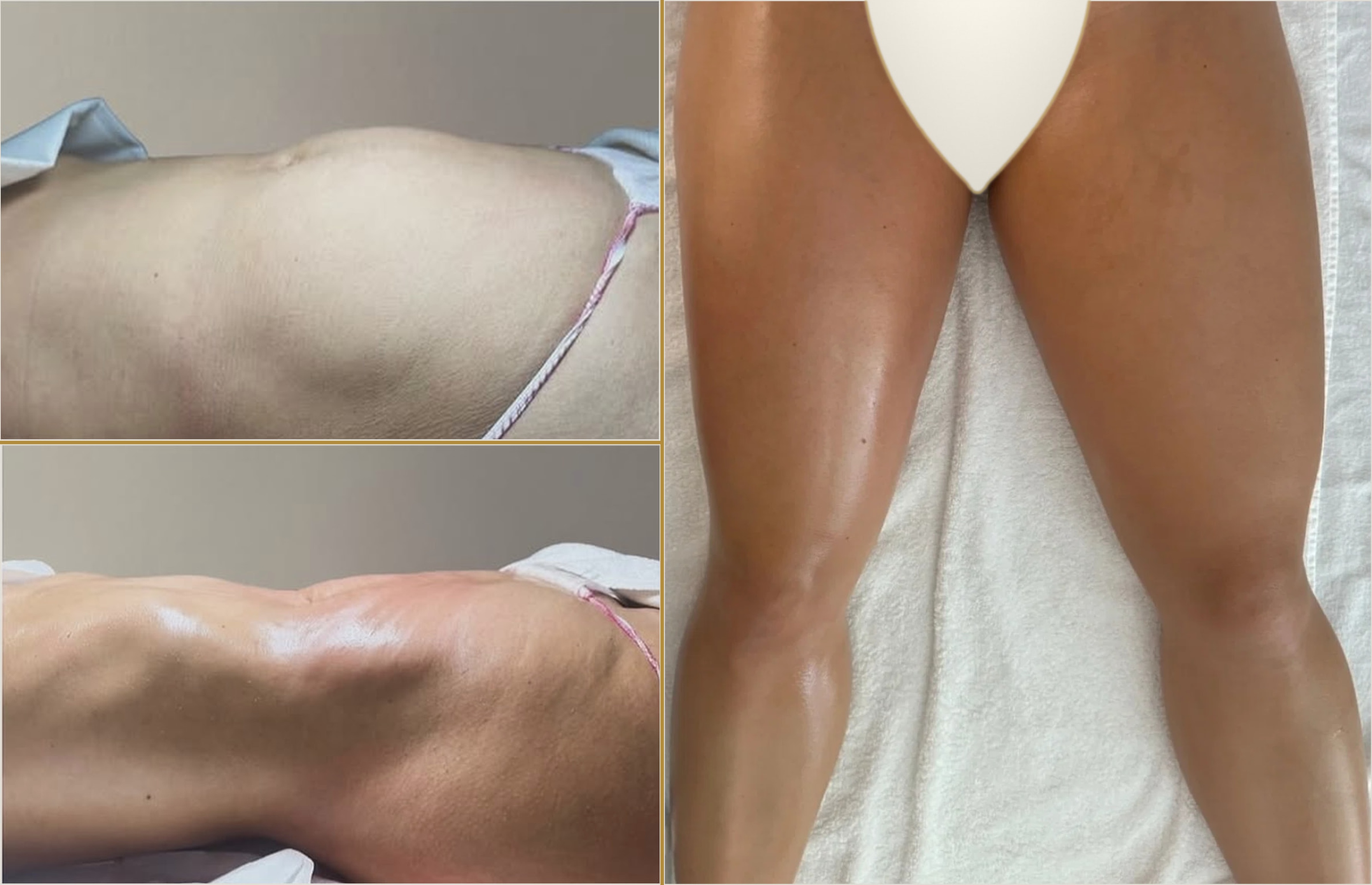NOMI FULL BODY — real client documentation of Zone 1 (abdomen & hips, before and after) and Zone 2 (treated versus untreated leg)